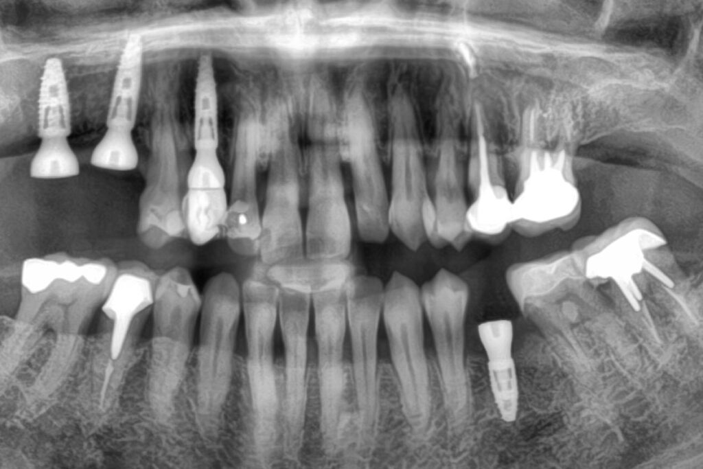 Le surfaçage parodontal implant dentaire