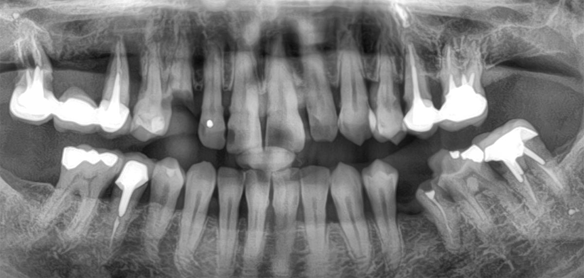 Le surfaçage parodontal implant dentaire