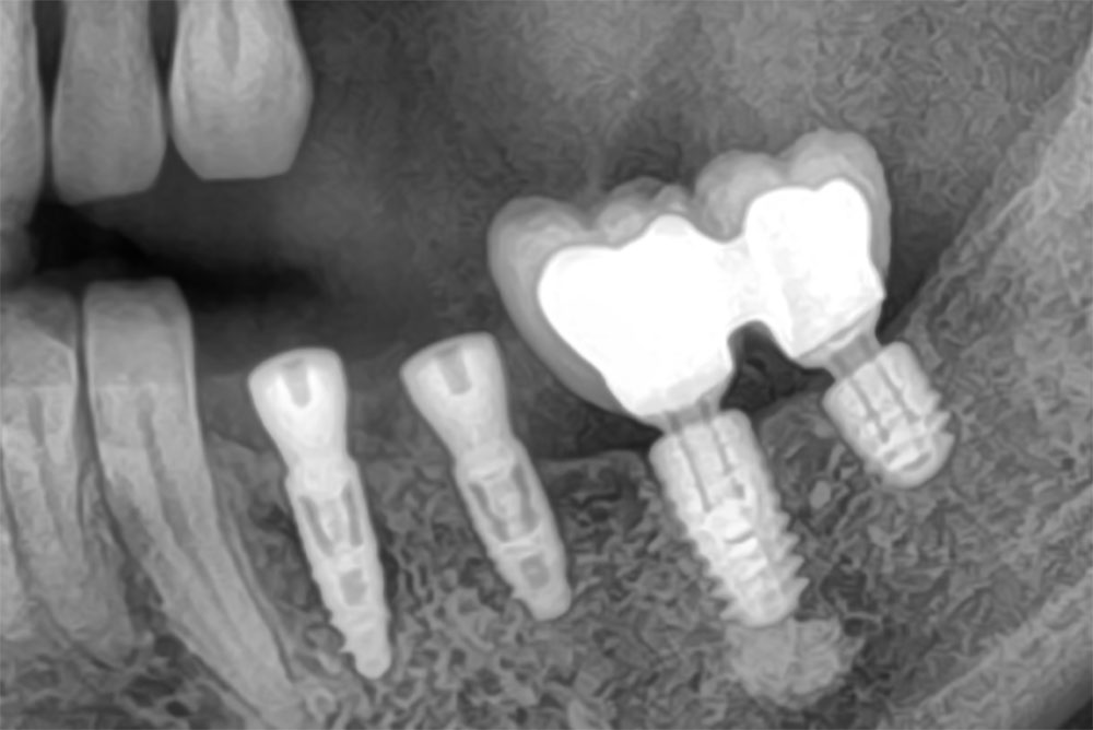 implant dentaire augmentation de crêtes osseuses