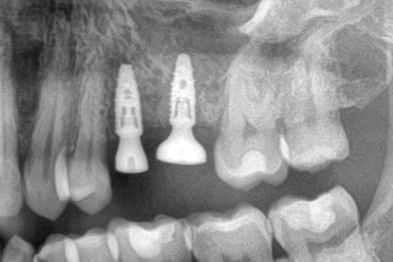 implant CAS CLINIQUE dentiste lyon