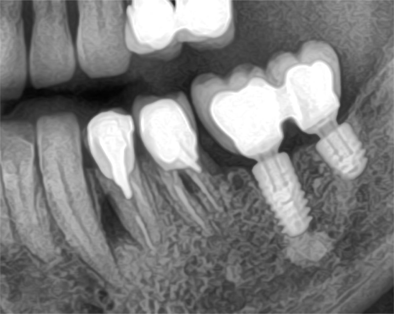 implant dentaire augmentation de crêtes osseuses